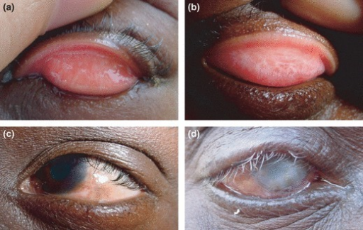 Historical treatments for trachoma