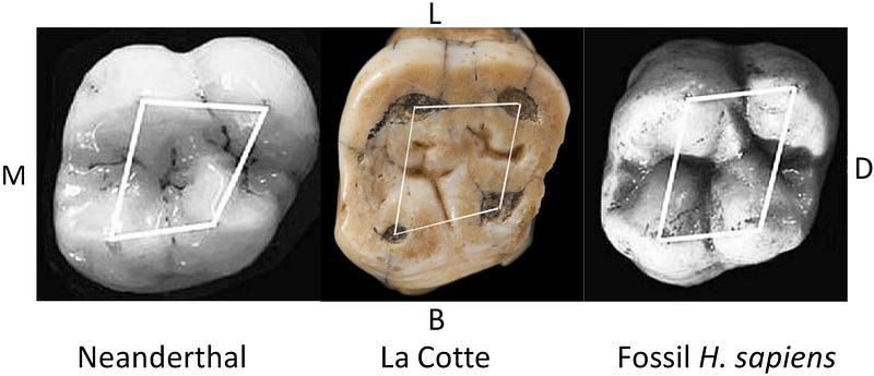 Comparison of Neanderthal and Homo sapiens dental structures