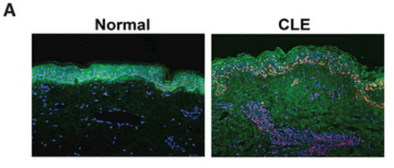 Apoptotic cells comparison in CLE